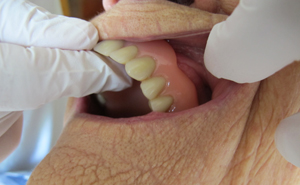 Tandprotesen er for stor