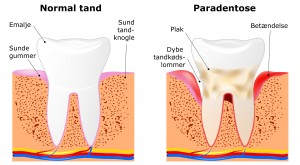 Hvordan opstår paradentose